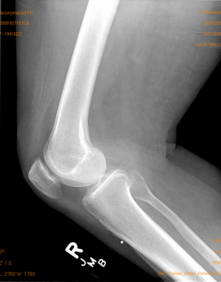 Knee X-Ray